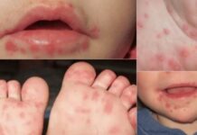 Con higiene se previene el Coxsackie; puede derivar en padecimientos graves, advierte la epidemióloga Ana Yee Es un virus altamente contagioso y común entre menores de cinco años