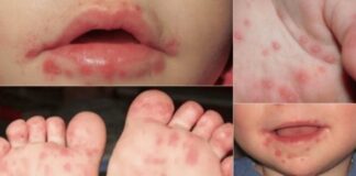 Con higiene se previene el Coxsackie; puede derivar en padecimientos graves, advierte la epidemióloga Ana Yee Es un virus altamente contagioso y común entre menores de cinco años