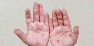 Por casos de coxsackie en Nuevo Laredo emiten alerta sanitaria en Tamaulipas Personal de salud realizó la búsqueda intencionada de posibles nuevos casos en los planteles