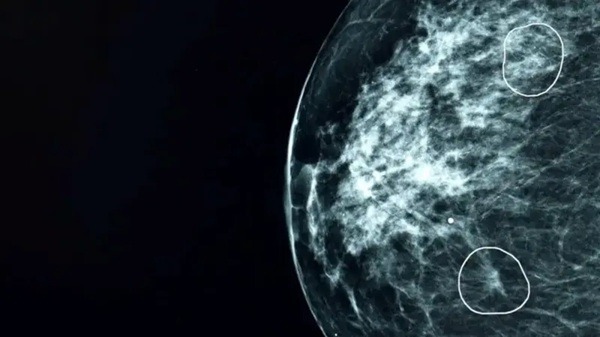 IA-Cáncer de Mama El profesor Gerald Lip, director clínico del programa de detección precoz de cáncer de mama en el noreste de Escocia, afirmó que los resultados demuestran que la IA podría "apoyar eficazmente" los servicios al aumentar la detección del cáncer y reducir la carga de trabajo.