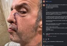 Tito Fuentes de Molotov es hospitalizado para una cirugía derivada de problemas de adicciones El músico enfrenta las consecuencias de años de adicción a las drogas.