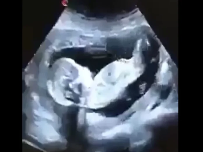 Niña embarazada en Matamoros, caso de posible agresión sexual